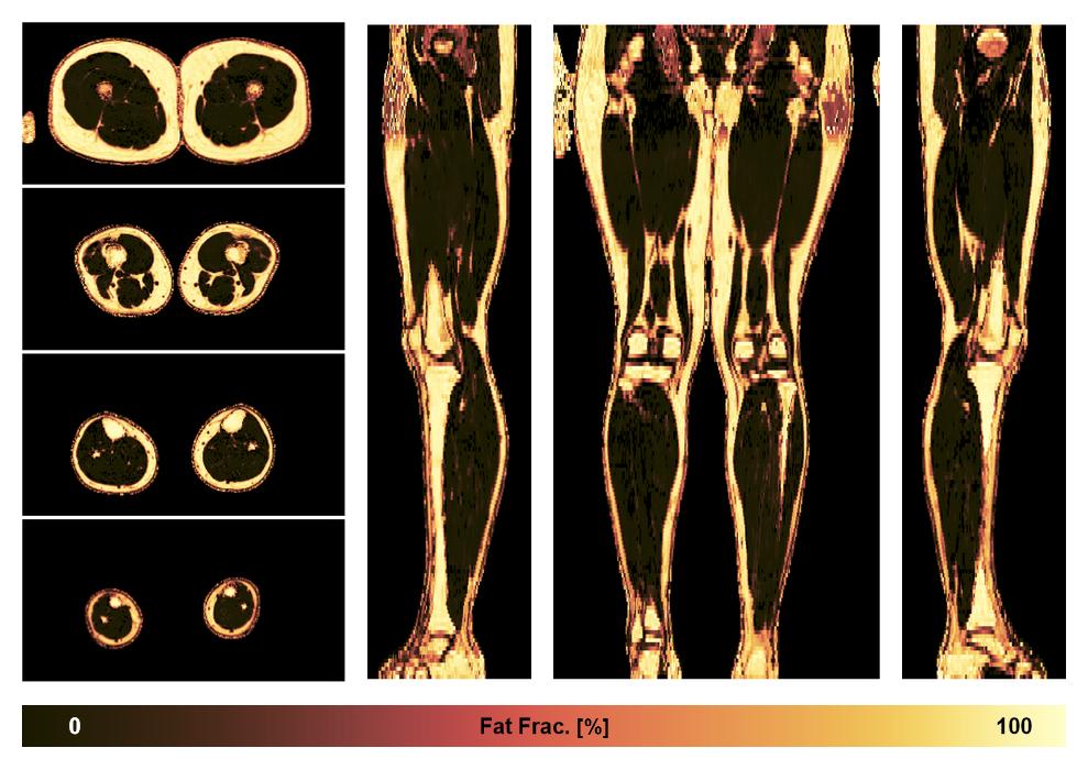 The fat fraction of the lower extremity obtained from the dixon reconstruction for muscle water fat quantification.